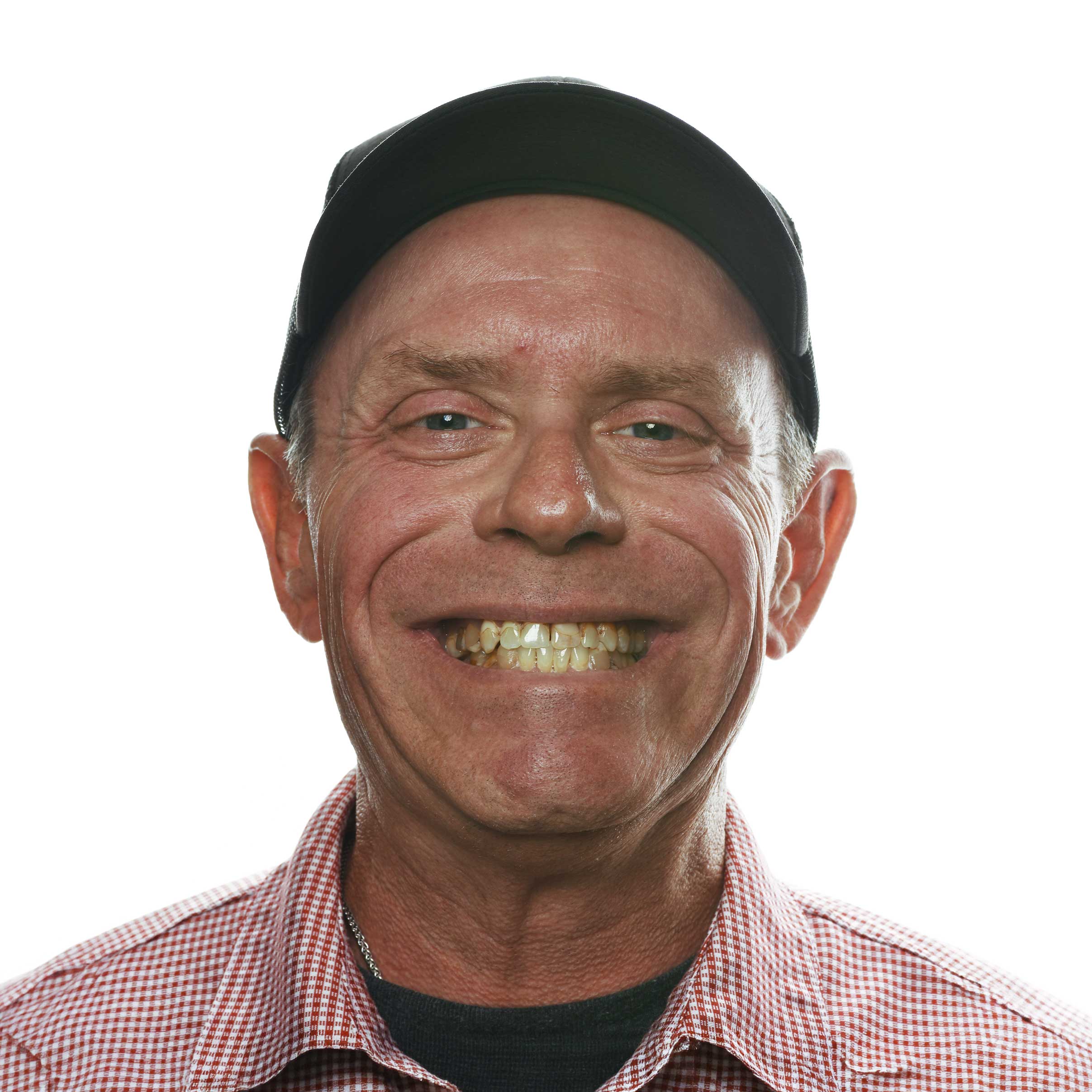 Full mouth All-On-X before and after — actual patient of Dr. DeWeese